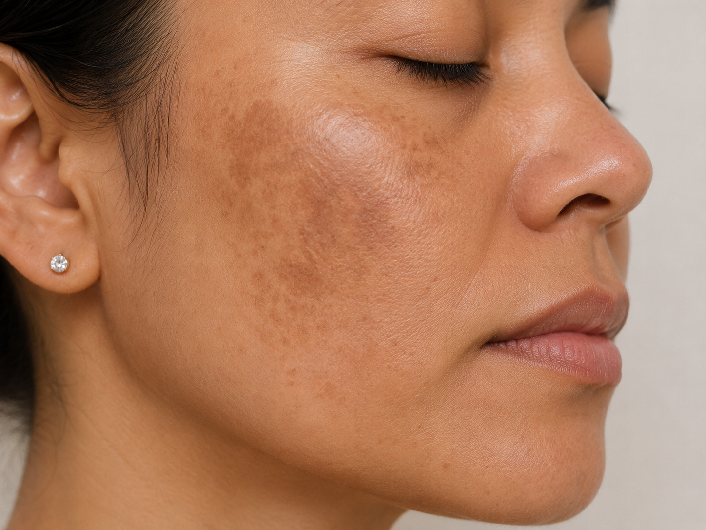 Hyperpigmentation